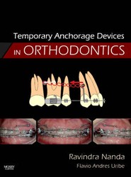 Temporary Anchorage Devices in Orthodontics