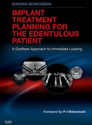 Implant Treatment Planning for the Edentulous Patient