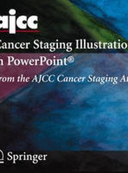 AJCC Cancer Staging Illustrations in PowerPoint
