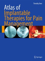 Atlas of Implantable Therapies for Pain Management