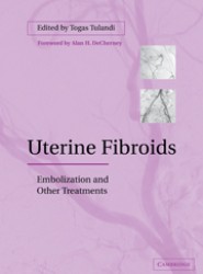 Uterine Fibroids