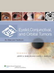 Eyelid, Conjunctival, and Orbital Tumors