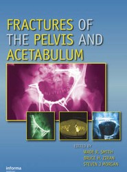 Fractures of the Pelvis and Acetabulum