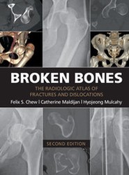 Broken Bones