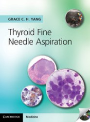 Thyroid Fine Needle Aspiration with CD Extra