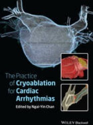 The Practice of Catheter Cryoablation for Cardiac Arrhythmias