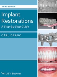Implant Restorations