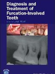 Diagnosis and Treatment of Furcation-Involved Teeth