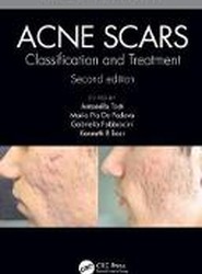 Acne Scars