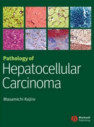 Pathology of Hepatocellular Carcinoma