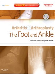 Arthritis and Arthroplasty: The Foot and Ankle