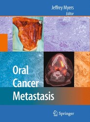 Oral Cancer Metastasis