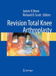 Revision Total Knee Arthroplasty