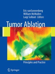 Tumor Ablation