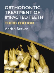 Orthodontic Treatment of Impacted Teeth