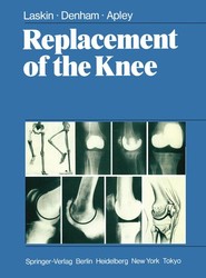Replacement of the Knee