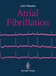 Atrial Fibrillation