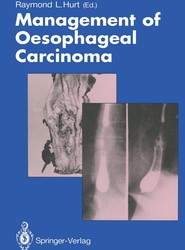 Management of Oesophageal Carcinoma