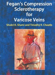 Fegan's Compression Sclerotherapy for Varicose Veins