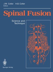 Spinal Fusion