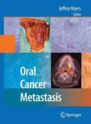 Oral Cancer Metastasis
