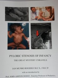 Pyloric Stenosis of Infancy