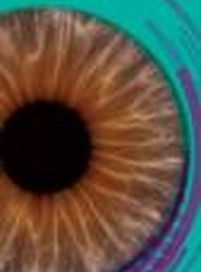 Strabismus in Children