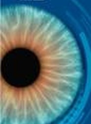 Pinguecula y Pterigion