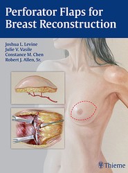 Perforator Flaps for Breast Reconstruction