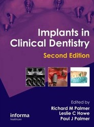 Implants in Clinical Dentistry