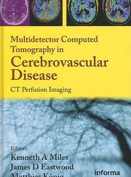 Multidetector Computed Tomography in Cerebrovascular Disease