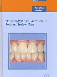 Indirect Restorations