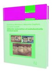 Adhesive Restoration of Endodontically Treated Teeth