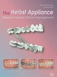 The Herbst Appliance