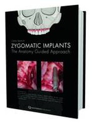 Zygomatic Implant