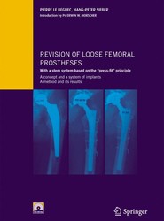Revision of loose femoral prostheses with a stem system based on the "press-fit" principle