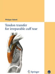 Tendon transfer for irreparable cuff tear