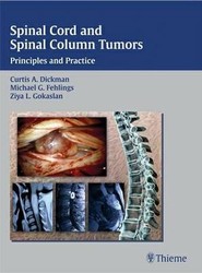 Spinal Cord and Spinal Column Tumors