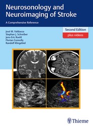 Neurosonology and Neuroimaging of Stroke
