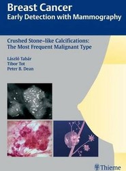 Breast Cancer: Early Detection with Mammography