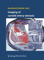 Imaging of Carotid Artery Stenosis