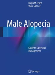 Male Alopecia