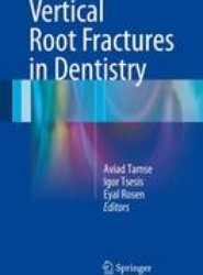 Vertical Root Fractures in Dentistry