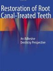 Restoration of Root Canal-Treated Teeth