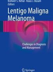 Lentigo Maligna Melanoma