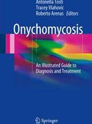 Onychomycosis