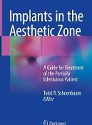 Implants in the Aesthetic Zone