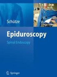 Epiduroscopy