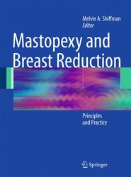 Mastopexy and Breast Reduction