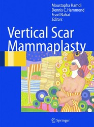 Vertical Scar Mammaplasty